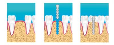 pose d'un implant dentaire à Sarcelles